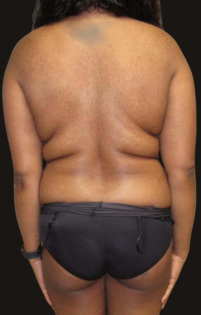 Abdominoplasty Before & After