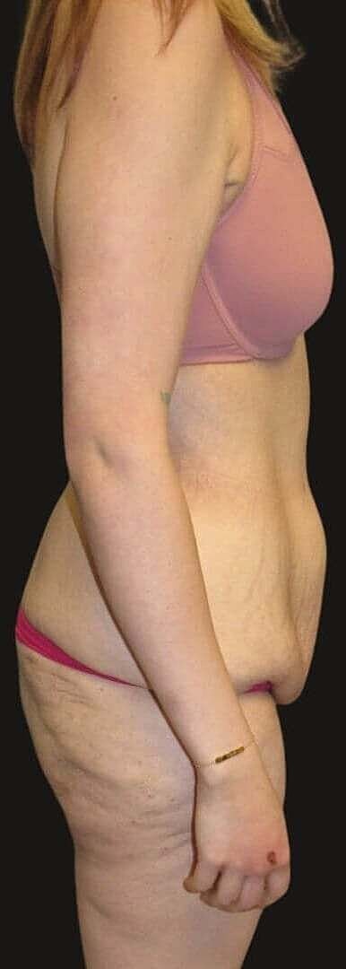 Abdominoplasty Before & After