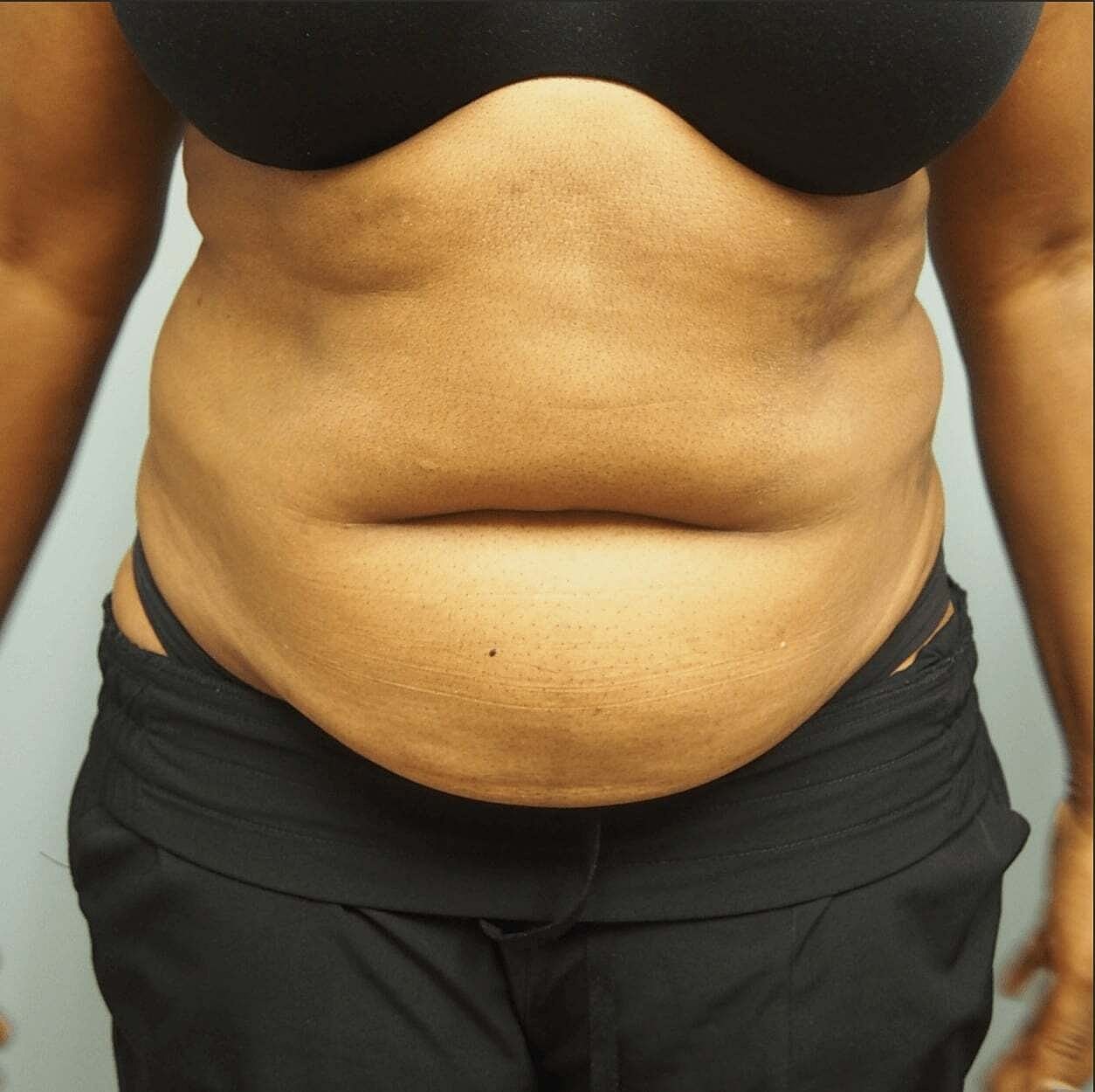 Abdominoplasty Before & After