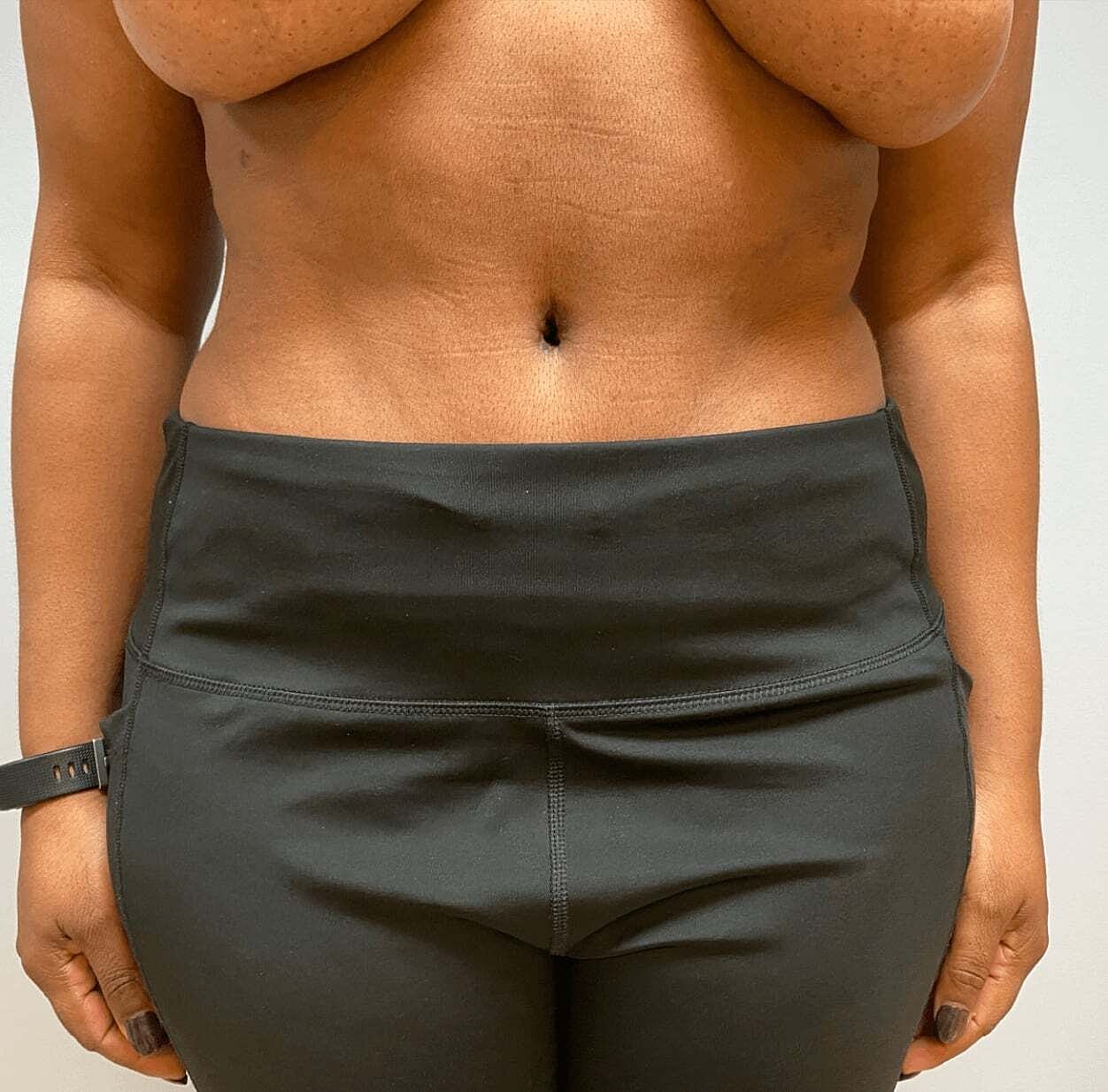 Abdominoplasty Before & After