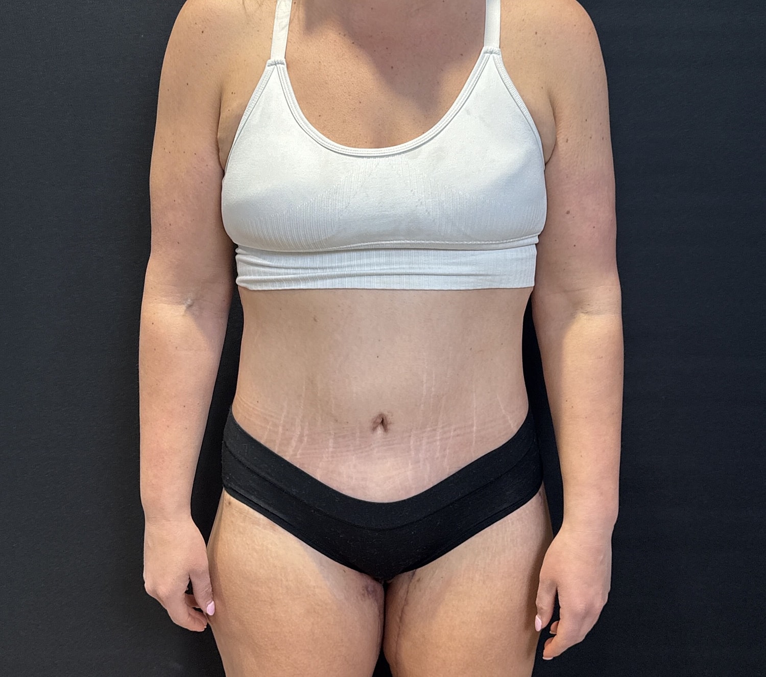 Abdominoplasty Before & After