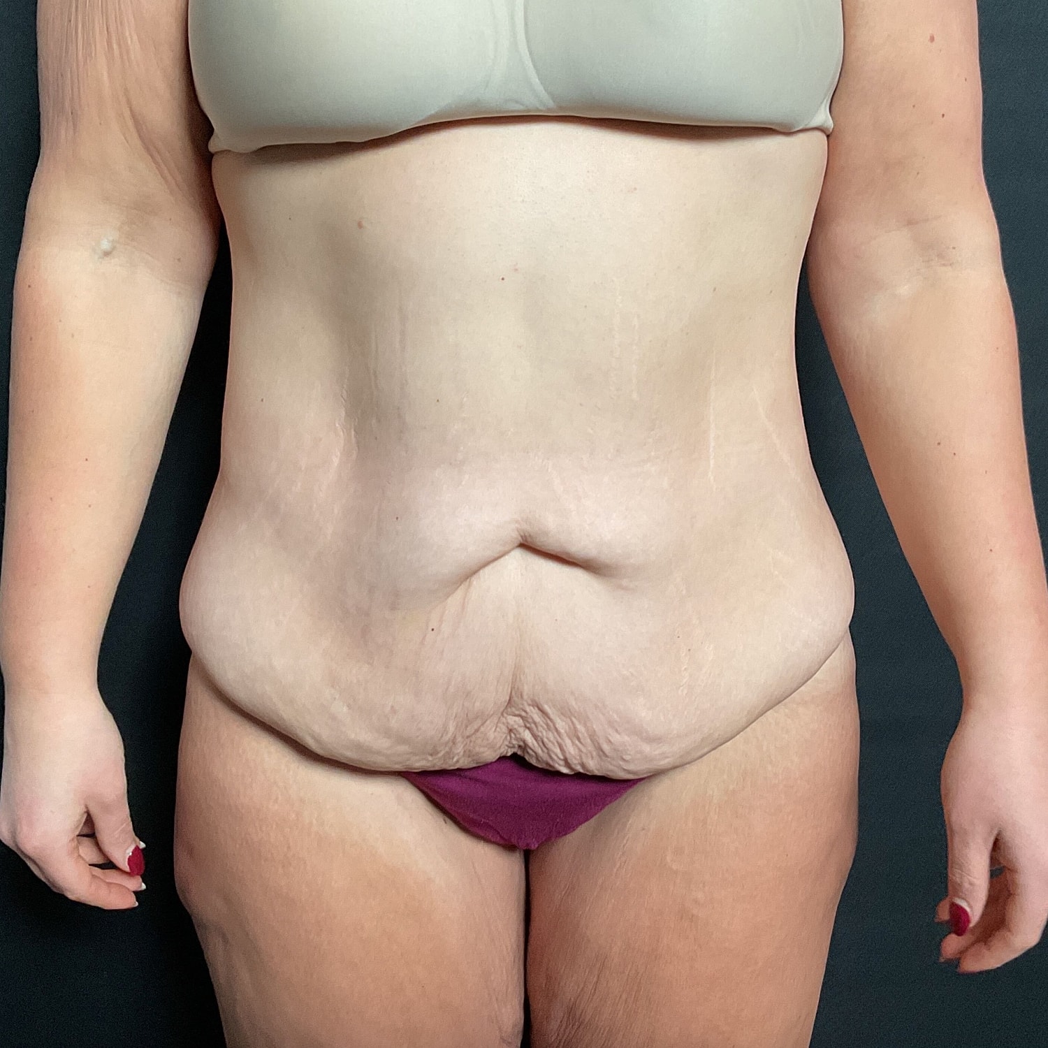 Abdominoplasty Before & After