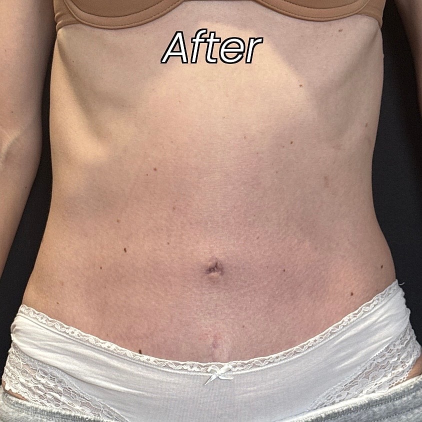 Abdominoplasty Before & After