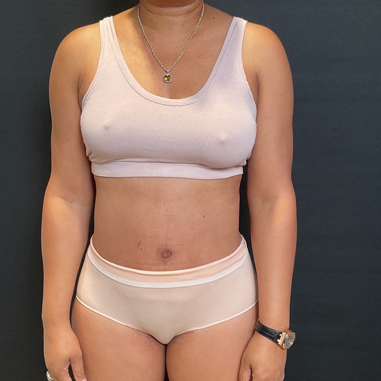 Abdominoplasty Before & After