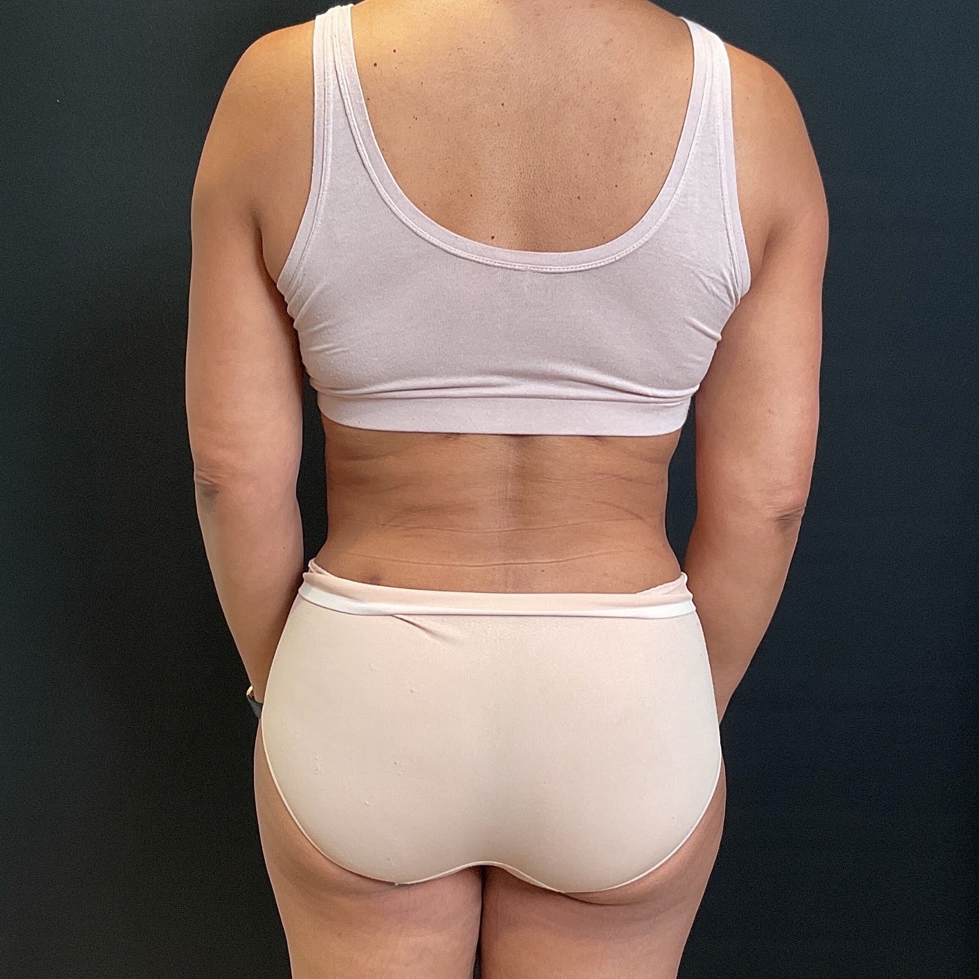 Abdominoplasty Before & After