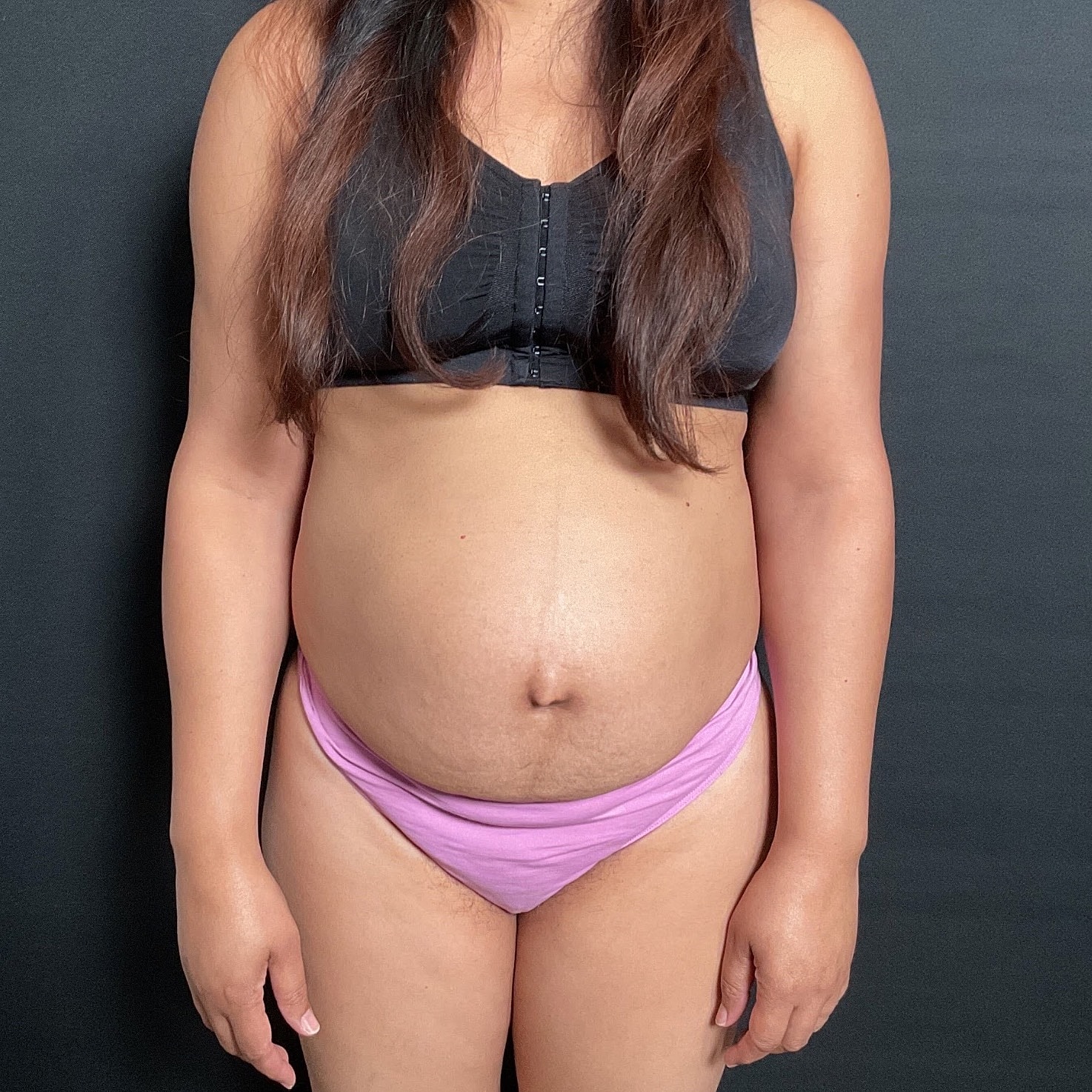Abdominoplasty Before & After