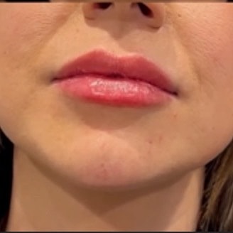 Derma Filler Before & After