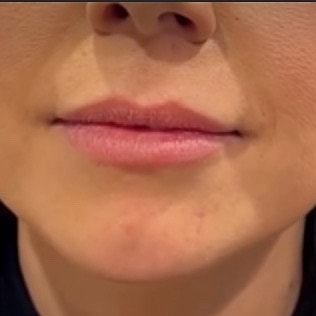 Derma Filler Before & After