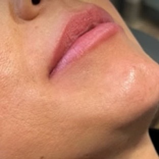 Derma Filler Before & After