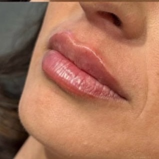 Derma Filler Before & After