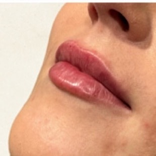 Derma Filler Before & After