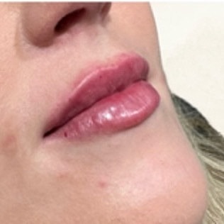Derma Filler Before & After