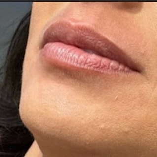 Derma Filler Before & After