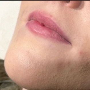Derma Filler Before & After