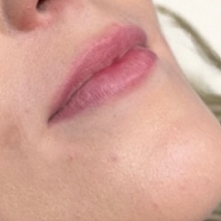Derma Filler Before & After