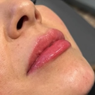 Derma Filler Before & After