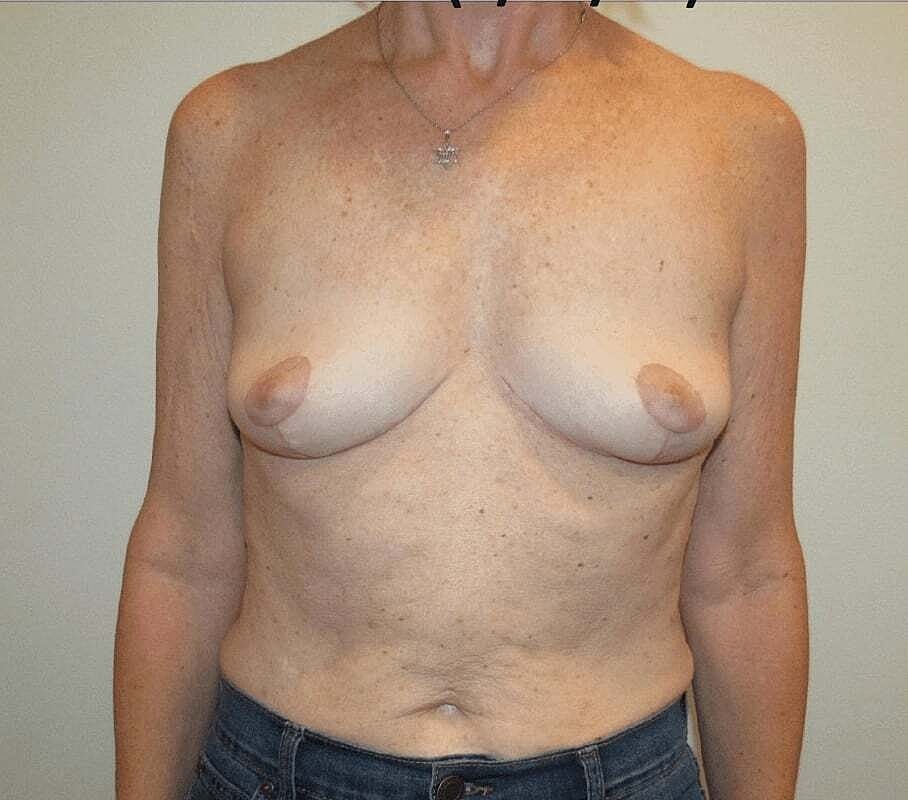 Breast Implant Removal Before & After