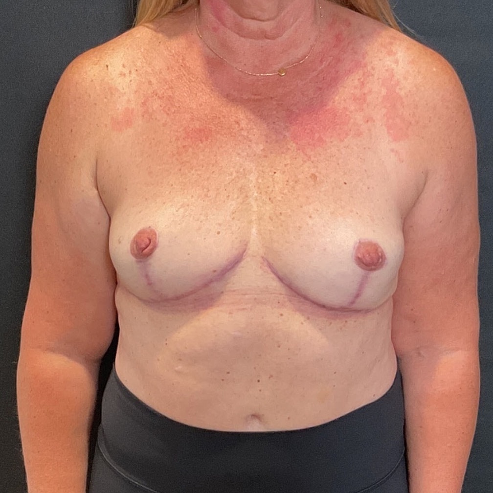 Breast Implant Removal Before & After