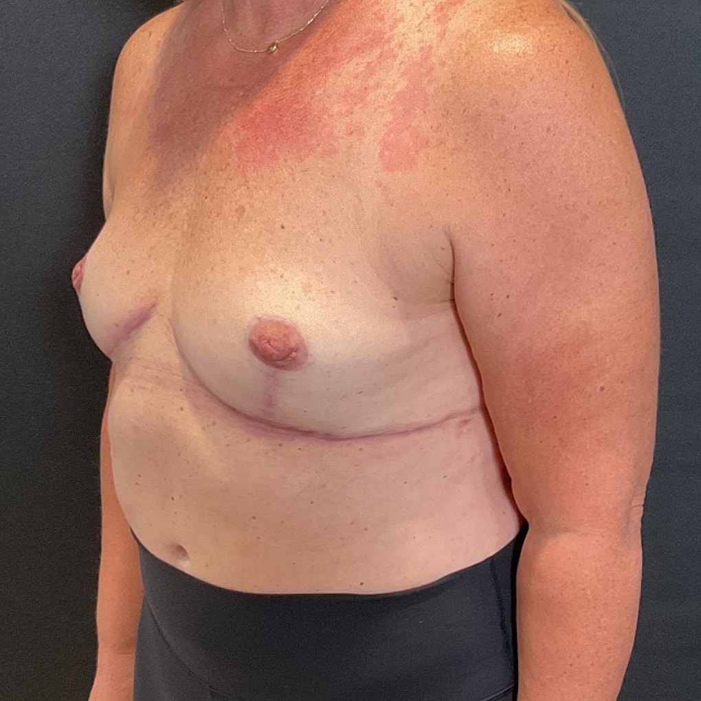 Breast Implant Removal Before & After