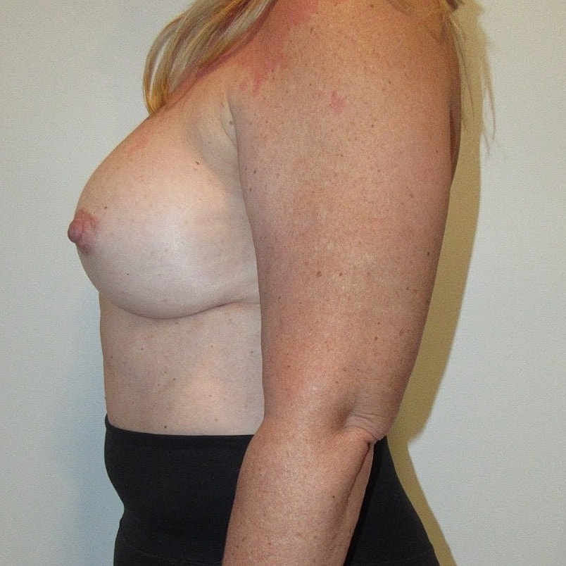 Breast Implant Removal Before & After