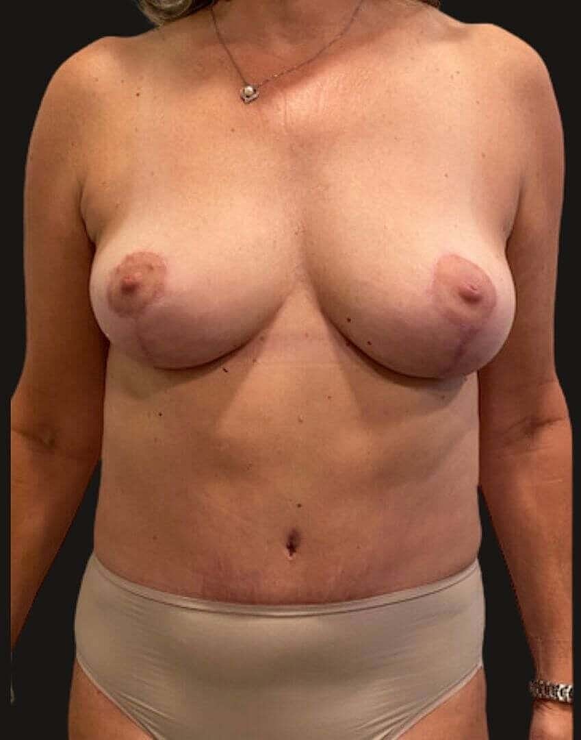 Mommy Makeover Before & After