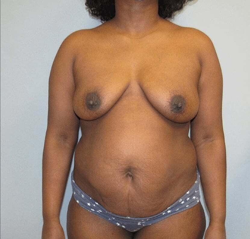 Mommy Makeover Before & After