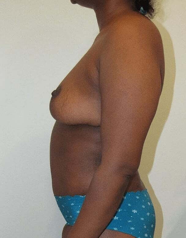 Mommy Makeover Before & After