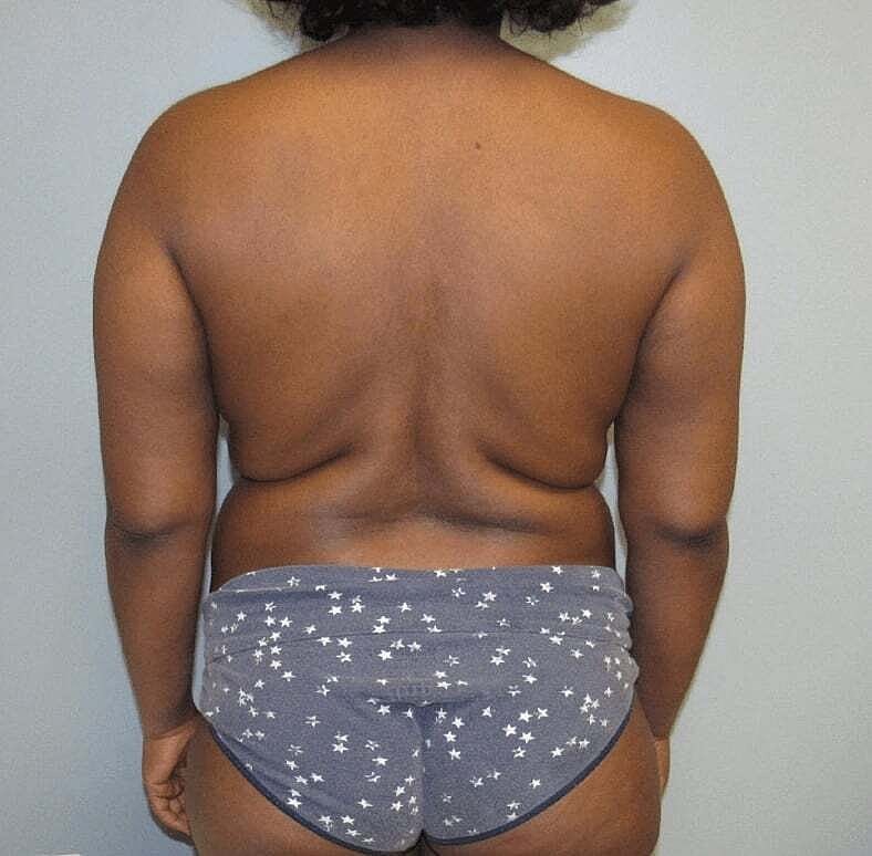 Mommy Makeover Before & After