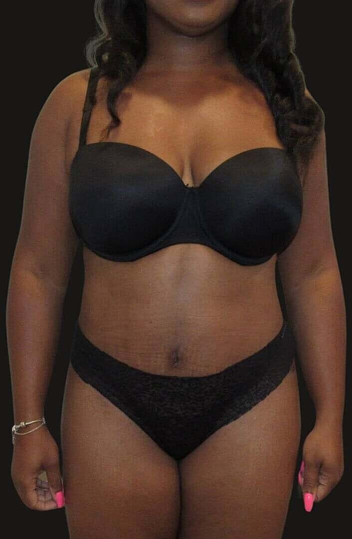 Liposuction Before & After