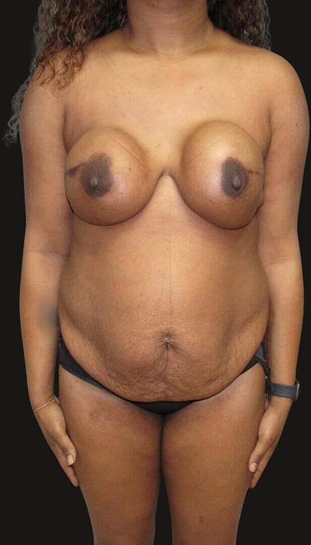 Liposuction Before & After