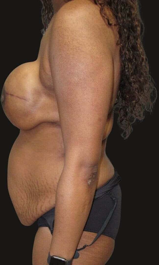 Liposuction Before & After