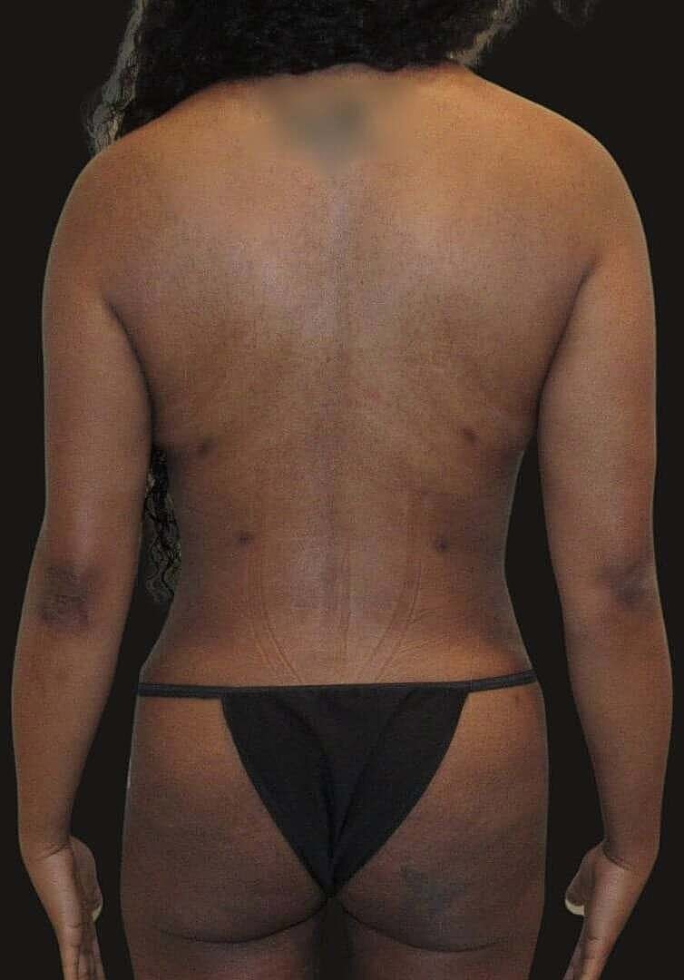 Liposuction Before & After