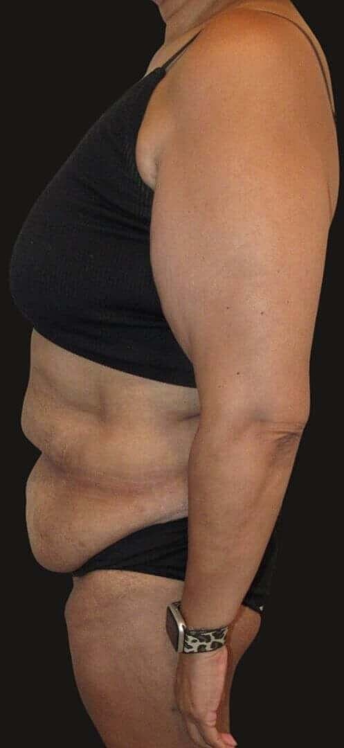 After Weight Loss Surgery Before & After