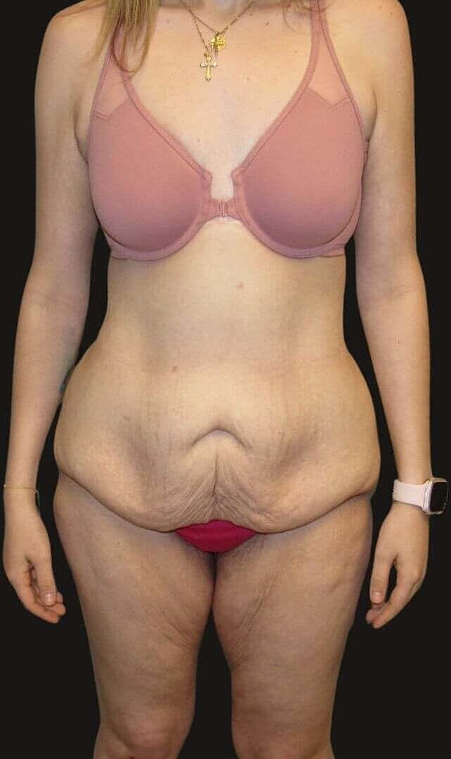 After Weight Loss Surgery Before & After