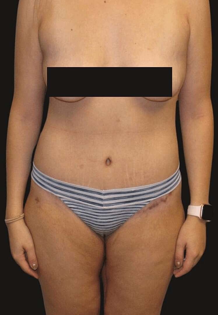 After Weight Loss Surgery Before & After