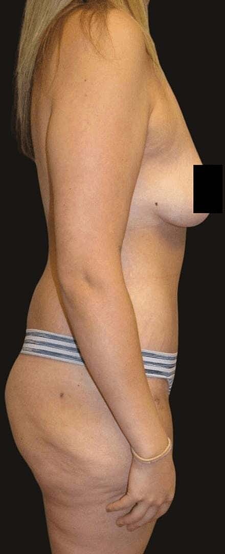 After Weight Loss Surgery Before & After