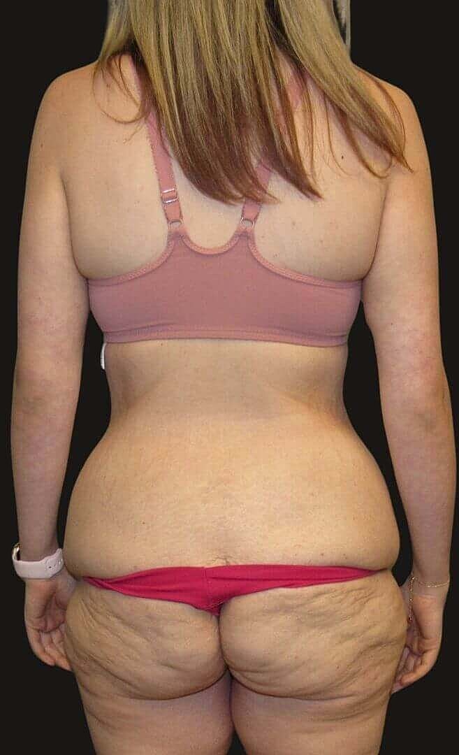 After Weight Loss Surgery Before & After