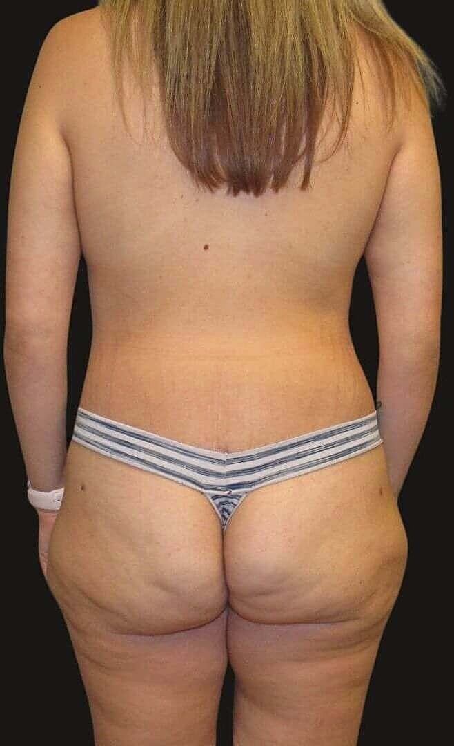 After Weight Loss Surgery Before & After
