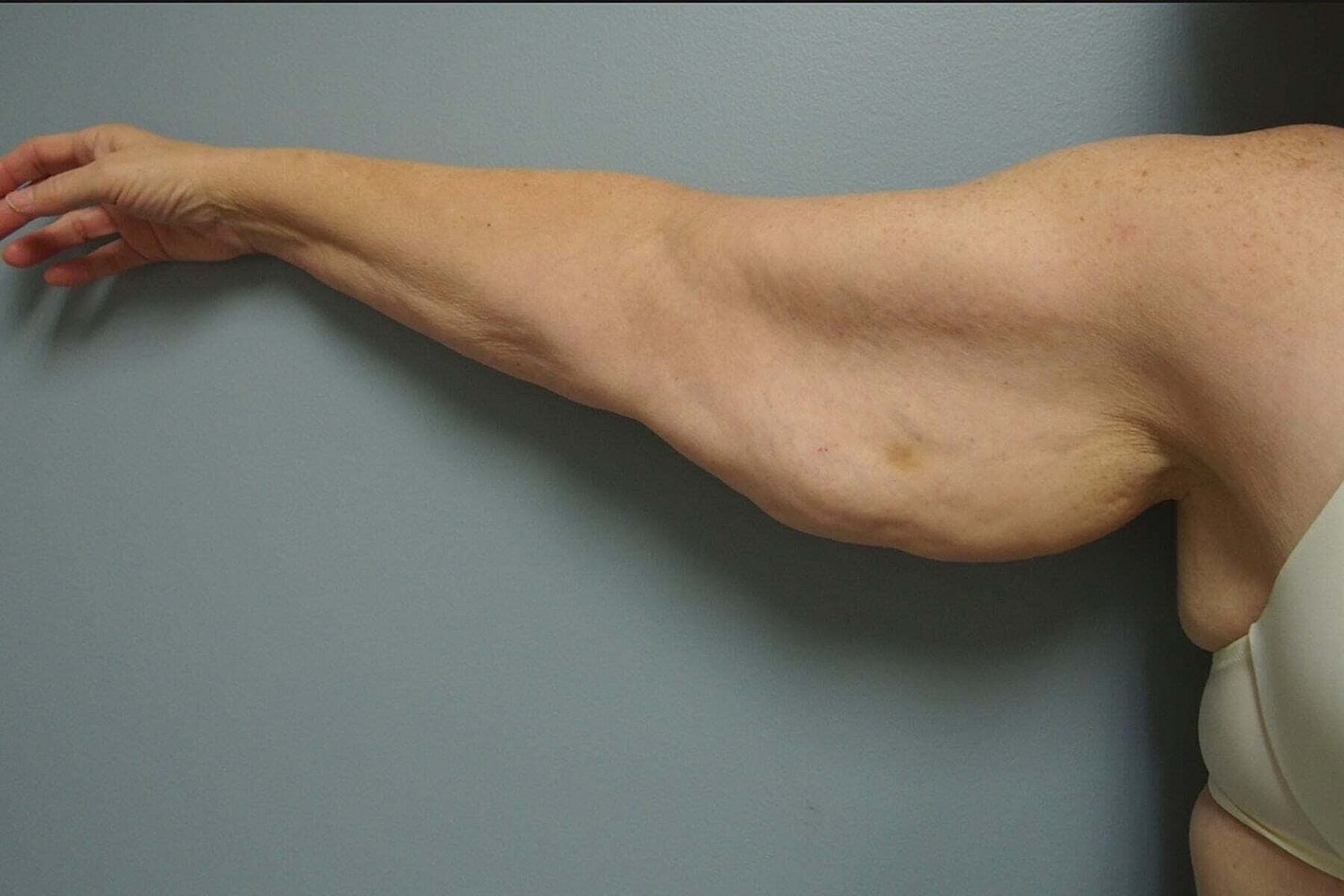 After Weight Loss Surgery Before & After