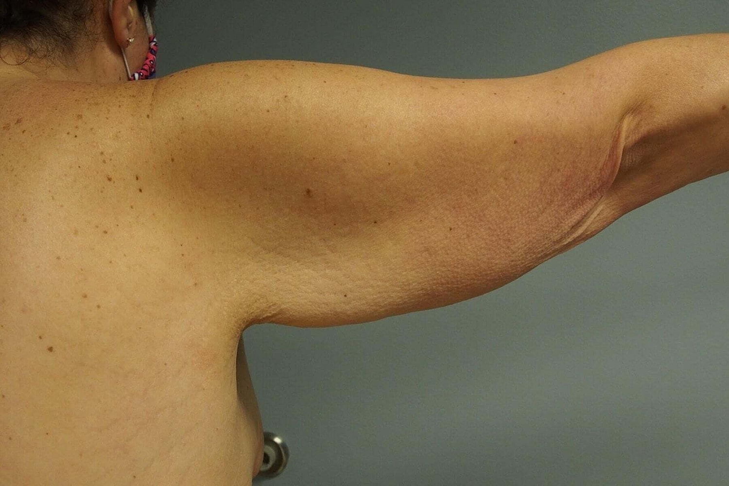 After Weight Loss Surgery Before & After