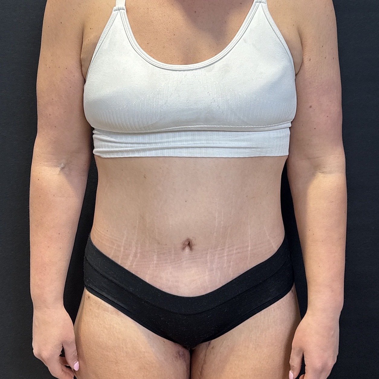 After Weight Loss Surgery Before & After