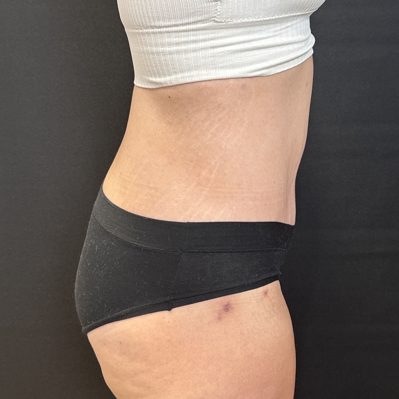 After Weight Loss Surgery Before & After