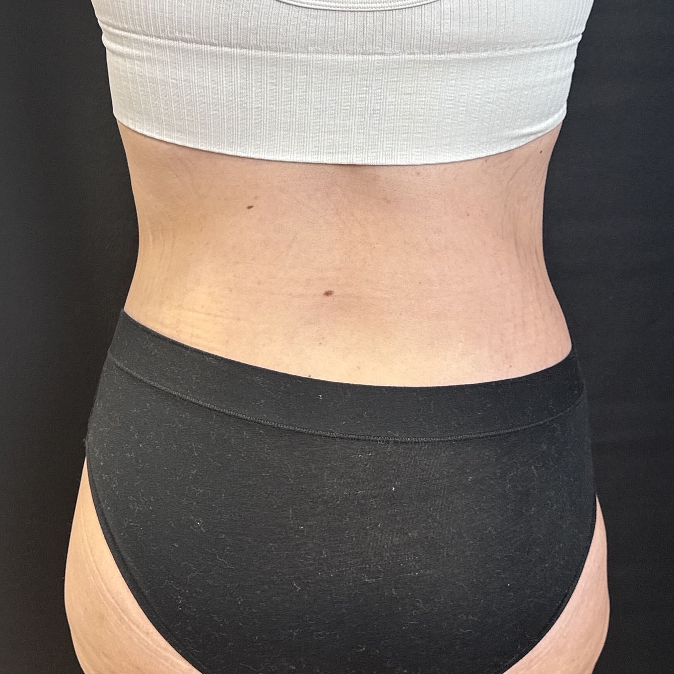 After Weight Loss Surgery Before & After