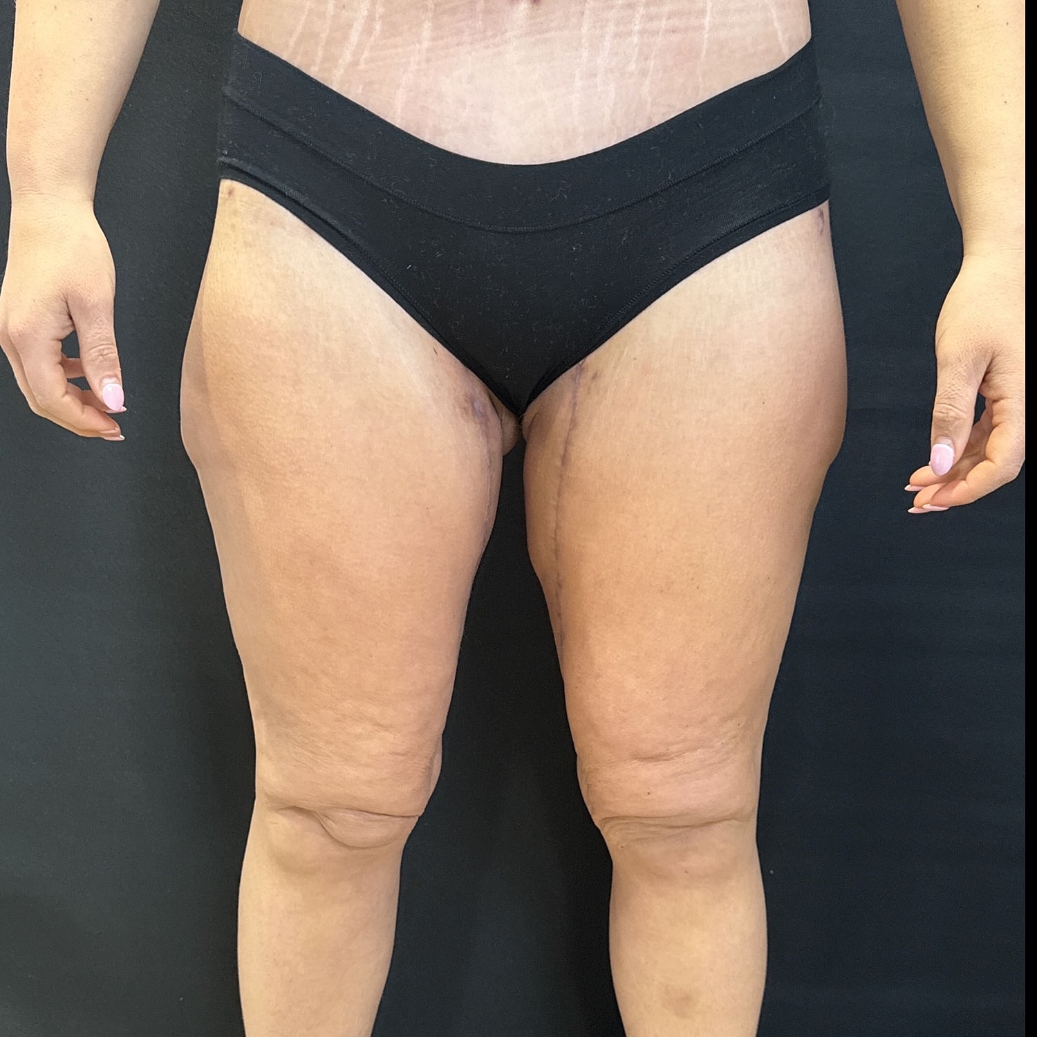 After Weight Loss Surgery Before & After