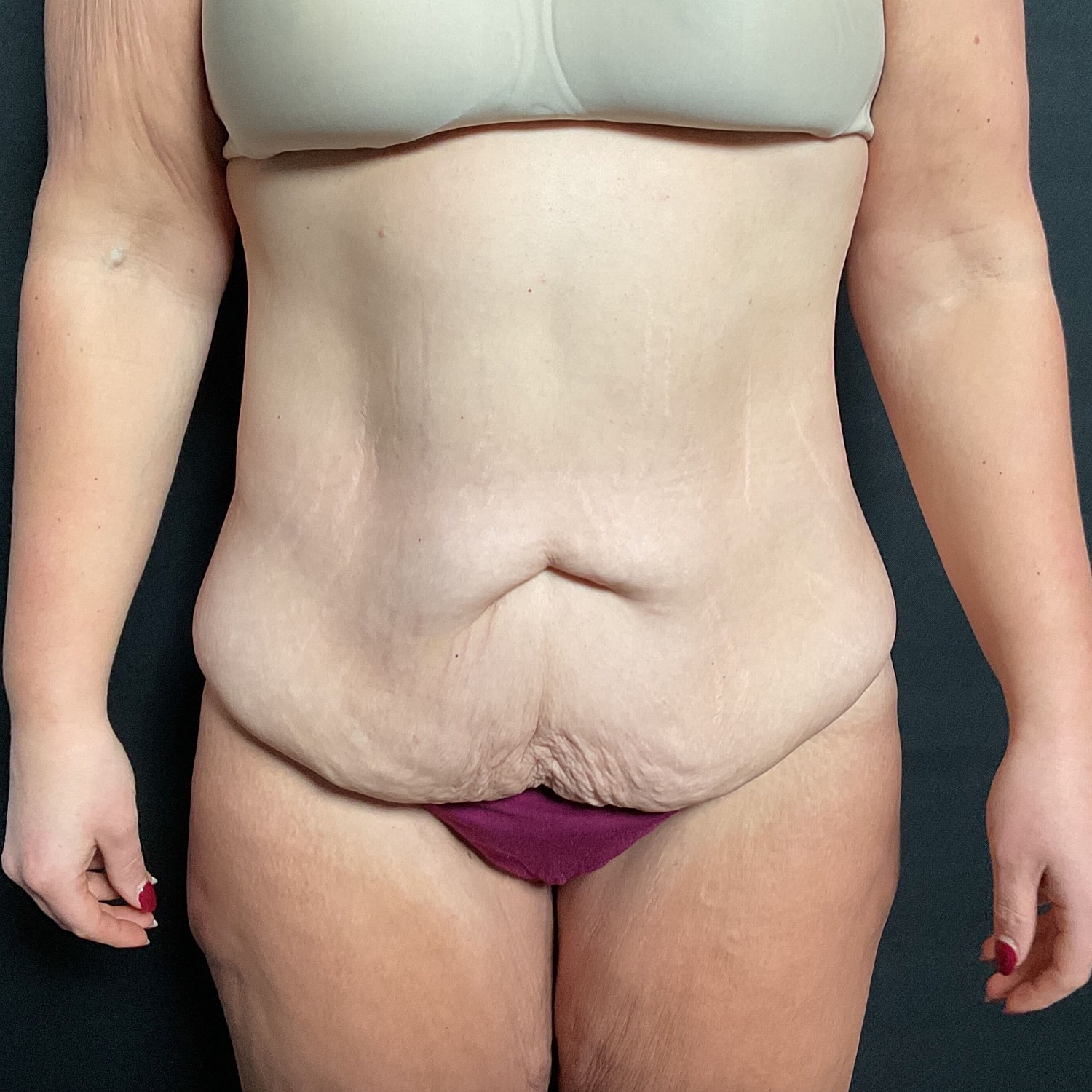 After Weight Loss Surgery Before & After