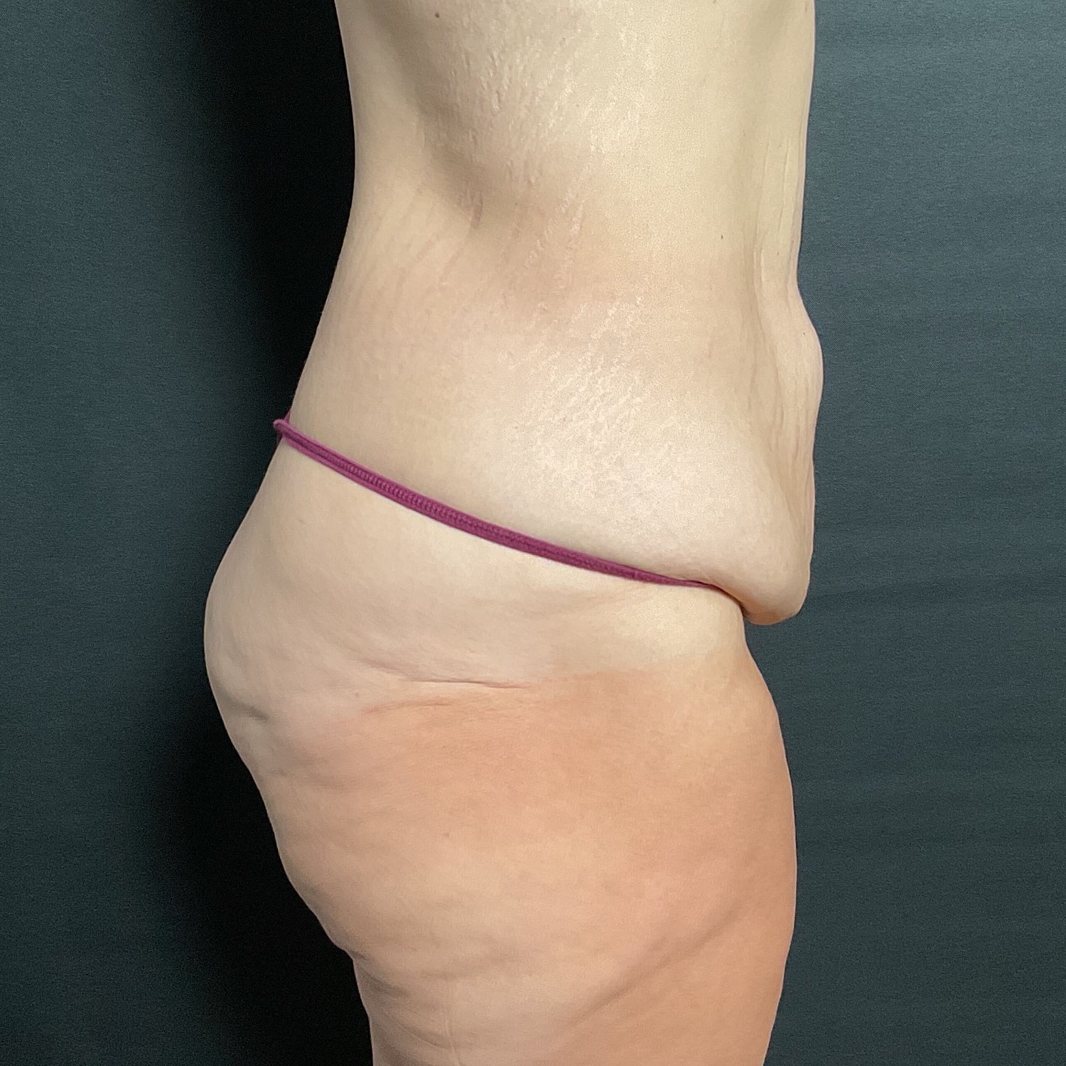 After Weight Loss Surgery Before & After