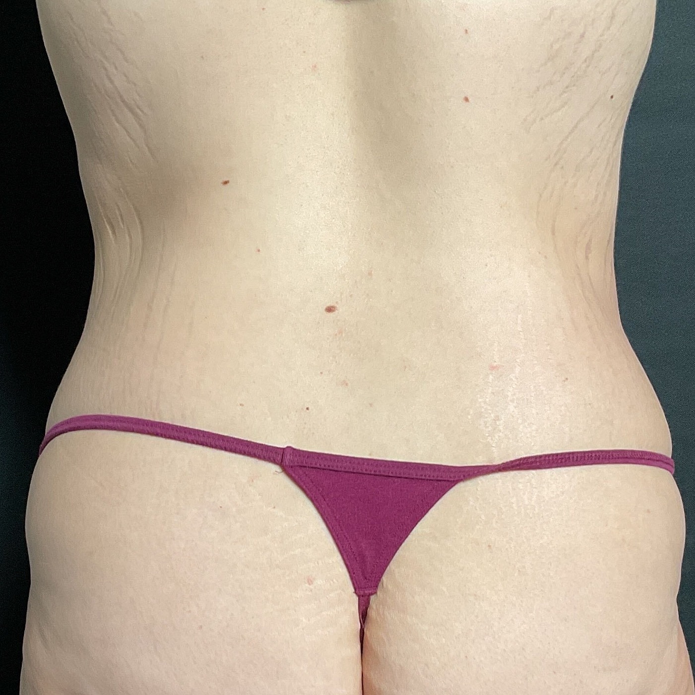 After Weight Loss Surgery Before & After