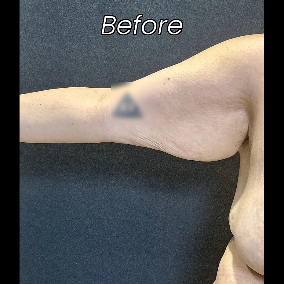 After Weight Loss Surgery Before & After