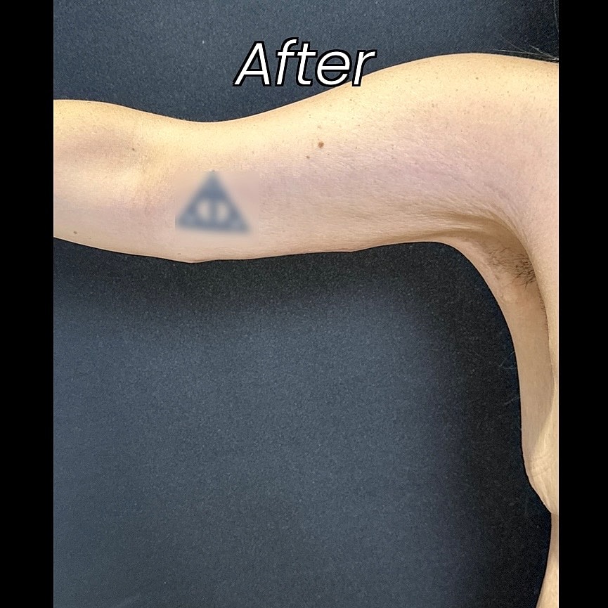 After Weight Loss Surgery Before & After
