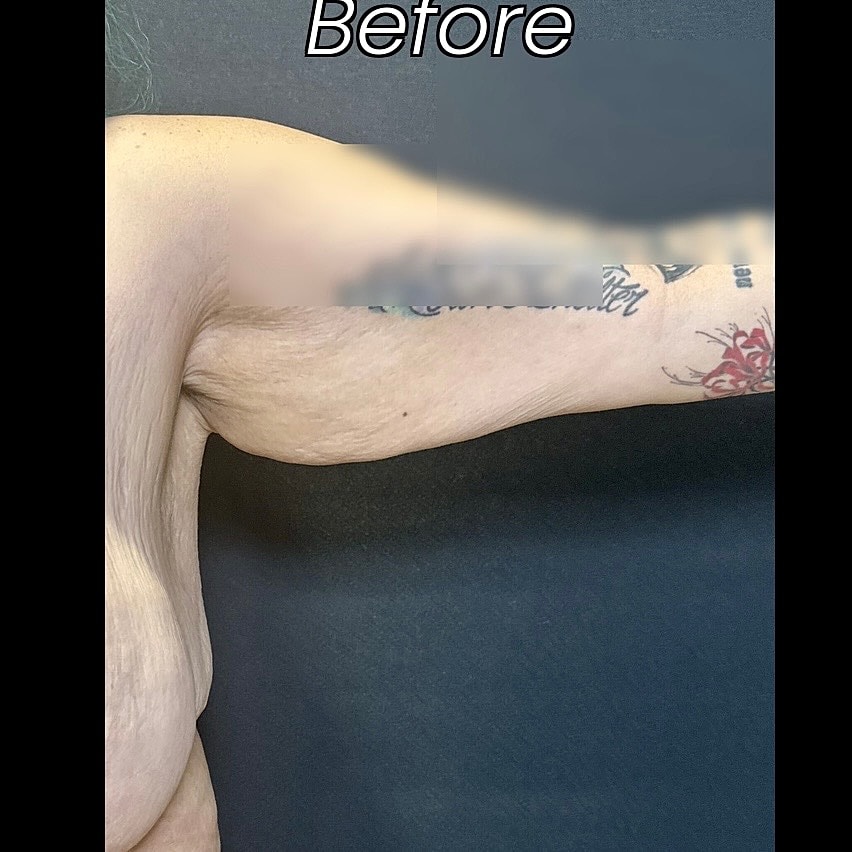 After Weight Loss Surgery Before & After